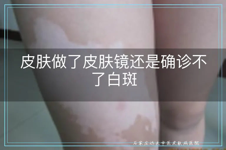 皮肤做了皮肤镜还是确诊不了白斑
