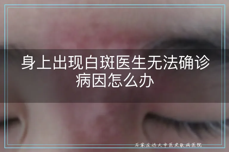 身上出现白斑医生无法确诊病因怎么办