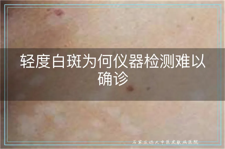 轻度白斑为何仪器检测难以确诊