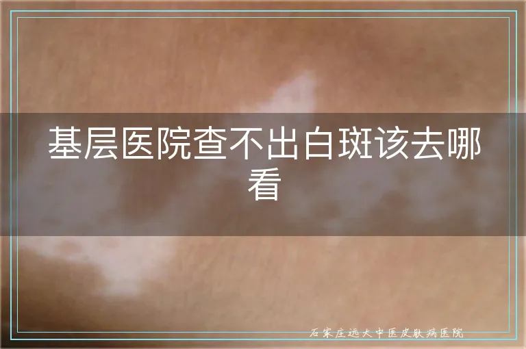 基层医院查不出白斑该去哪看
