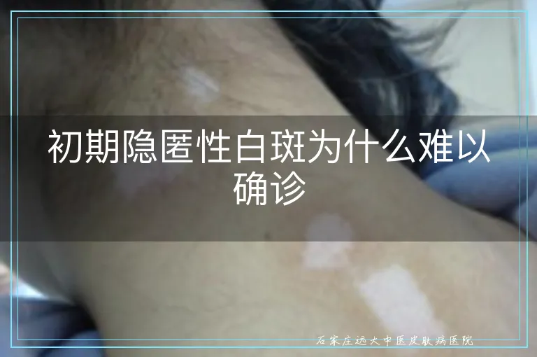 初期隐匿性白斑为什么难以确诊