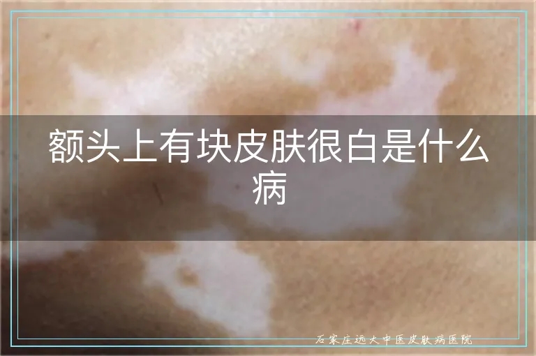 额头上有块皮肤很白是什么病