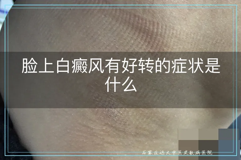 脸上白癜风有好转的症状是什么