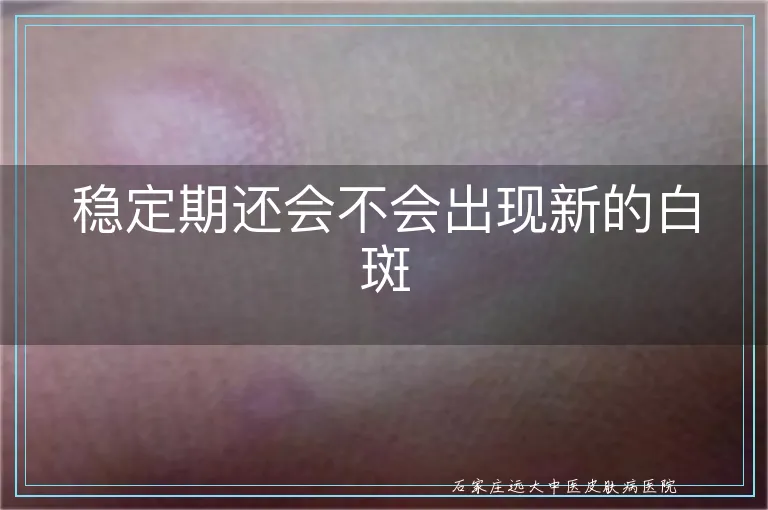 稳定期还会不会出现新的白斑