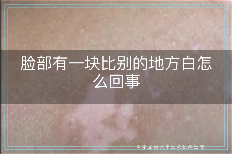 脸部有一块比别的地方白怎么回事
