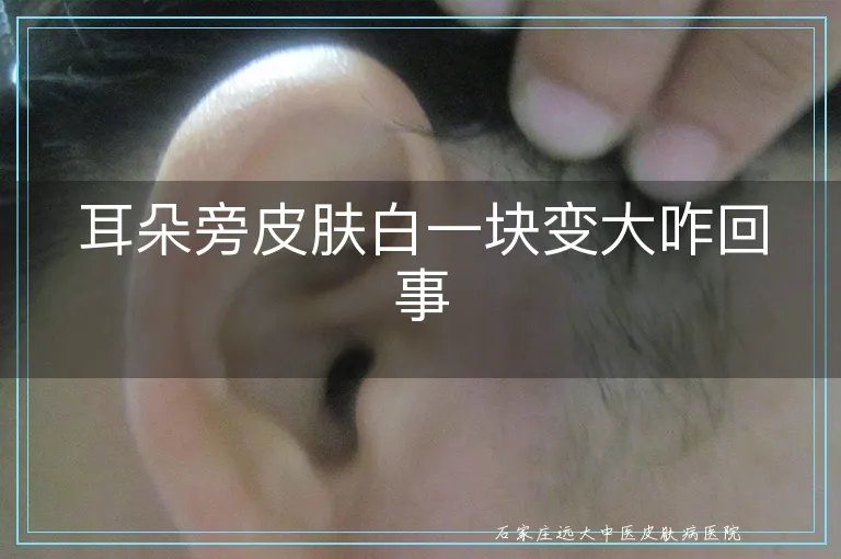 耳朵旁皮肤白一块变大咋回事