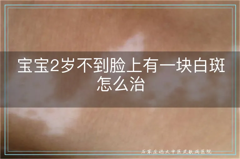 宝宝2岁不到脸上有一块白斑怎么治