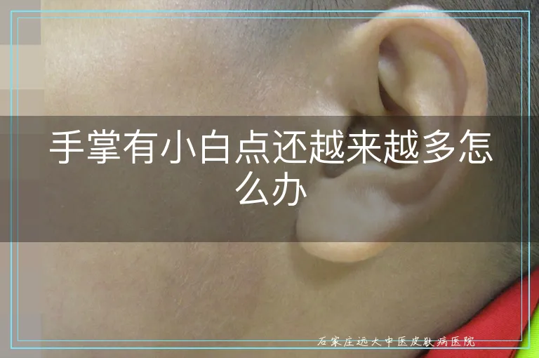手掌有小白点还越来越多怎么办