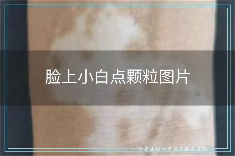 脸上小白点颗粒图片