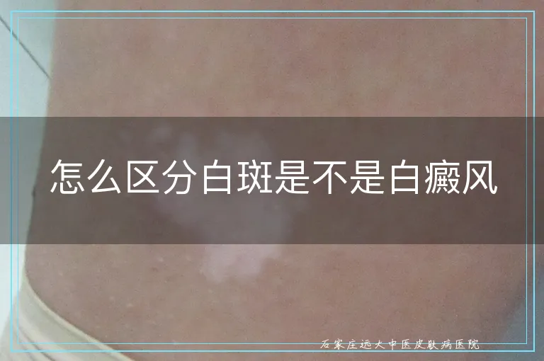 怎么区分白斑是不是白癜风