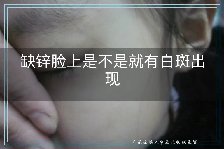缺锌脸上是不是就有白斑出现