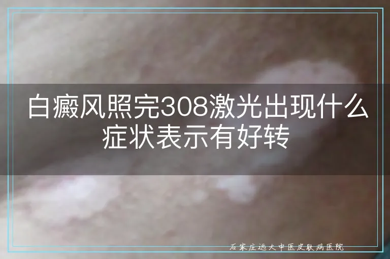 白癜风照完308激光出现什么症状表示有好转
