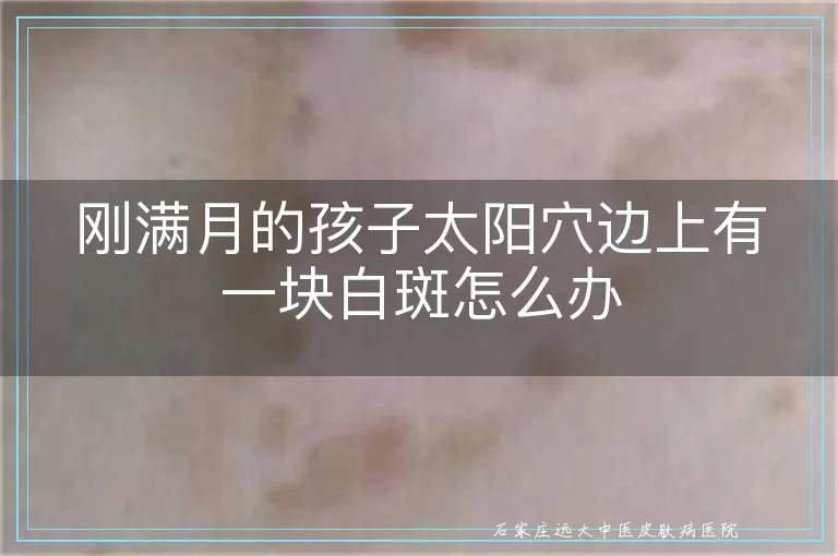 刚满月的孩子太阳穴边上有一块白斑怎么办