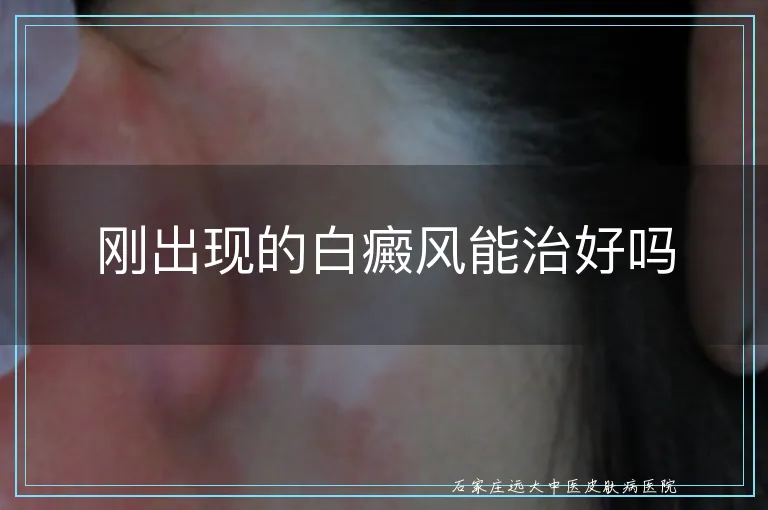 刚出现的白癜风能治好吗