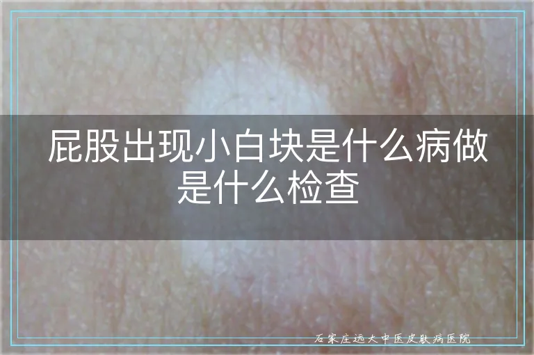 屁股出现小白块是什么病做是什么检查