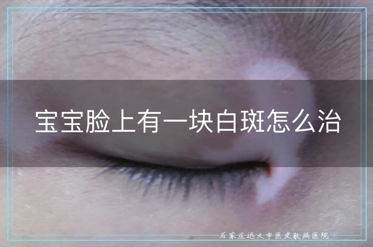 宝宝脸上有一块白斑怎么治