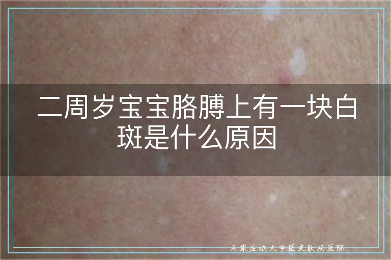 二周岁宝宝胳膊上有一块白斑是什么原因
