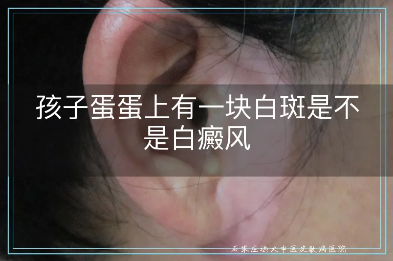 孩子蛋蛋上有一块白斑是不是白癜风