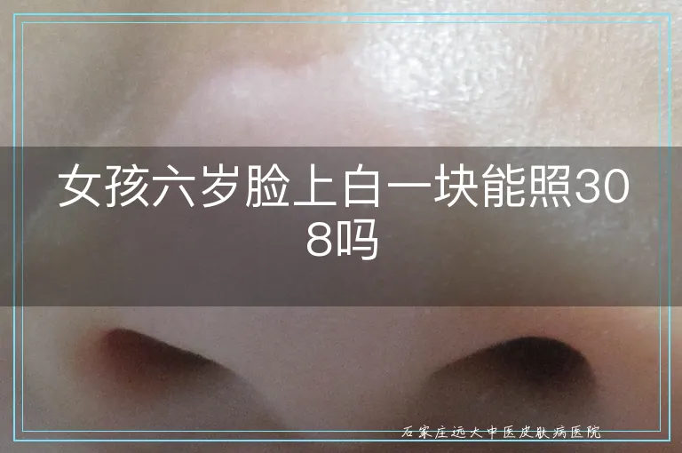 女孩六岁脸上白一块能照308吗