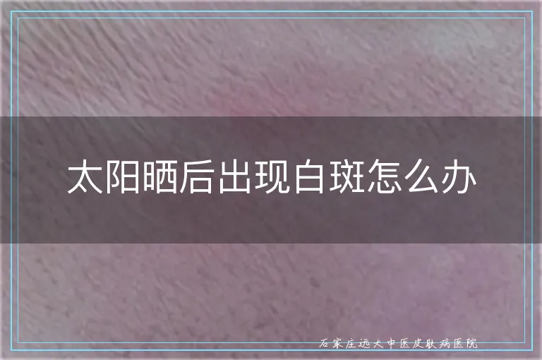 太阳晒后出现白斑怎么办