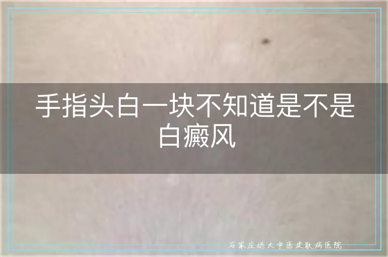 手指头白一块不知道是不是白癜风