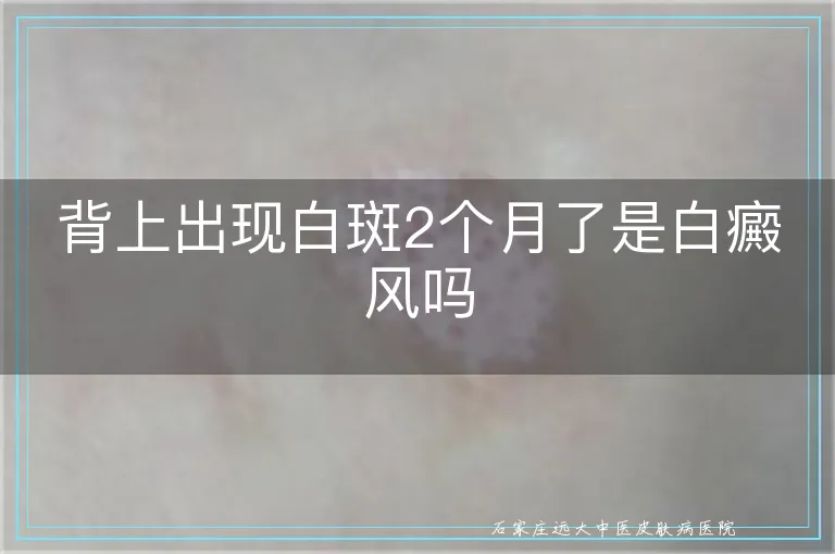 背上出现白斑2个月了是白癜风吗