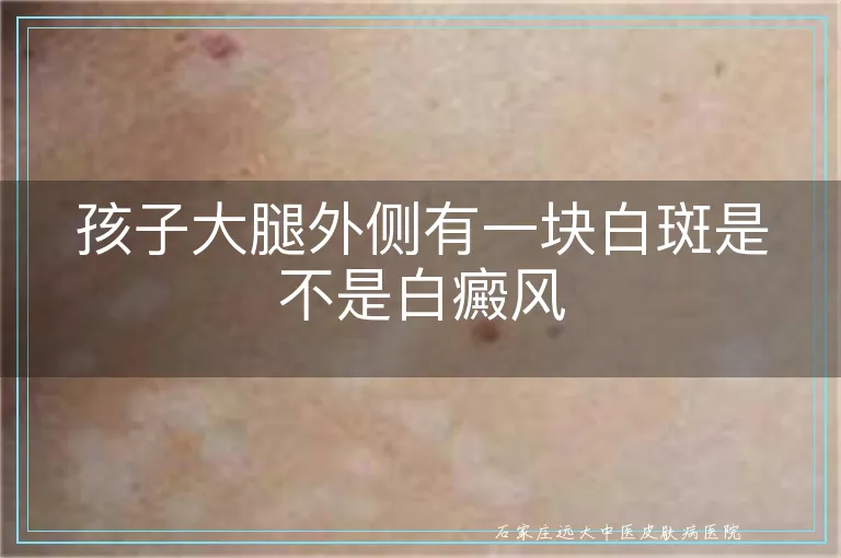 孩子大腿外侧有一块白斑是不是白癜风