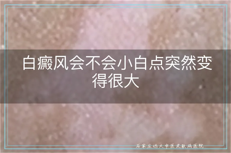 白癜风会不会小白点突然变得很大