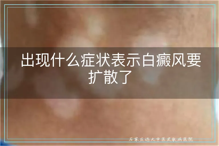出现什么症状表示白癜风要扩散了
