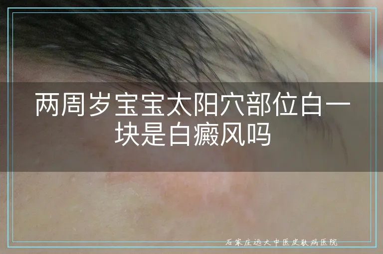 两周岁宝宝太阳穴部位白一块是白癜风吗