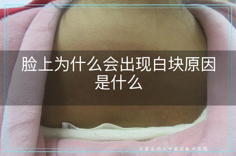 脸上为什么会出现白块原因是什么