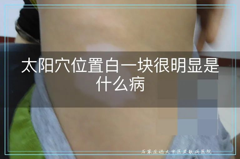太阳穴位置白一块很明显是什么病