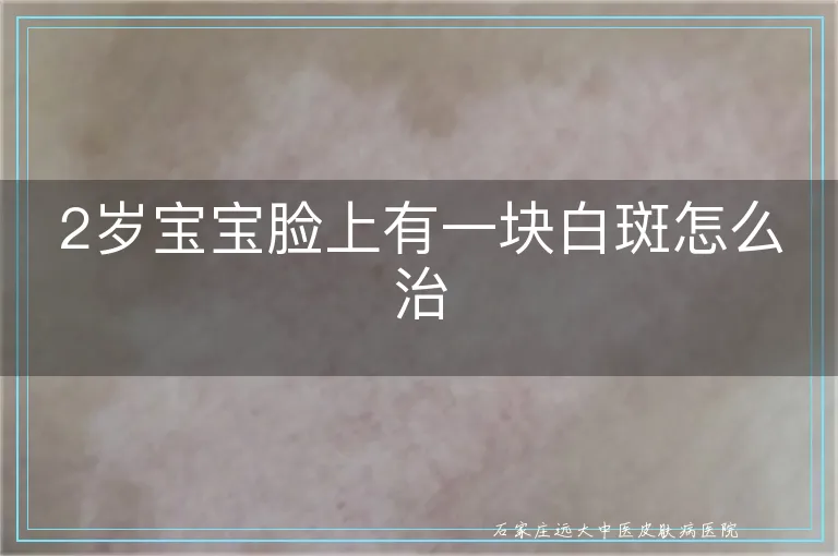 2岁宝宝脸上有一块白斑怎么治