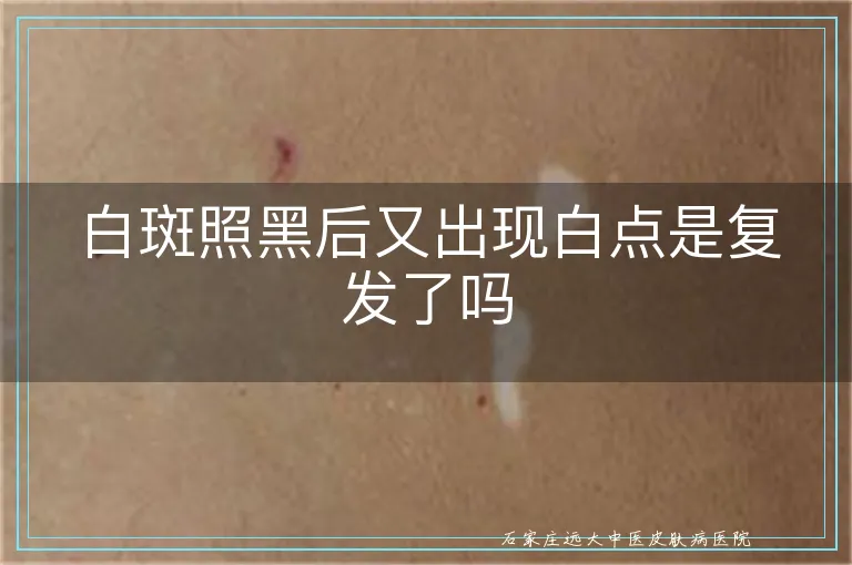 白斑照黑后又出现白点是复发了吗