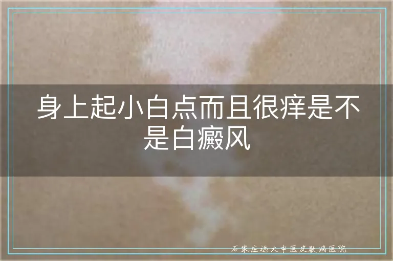 身上起小白点而且很痒是不是白癜风