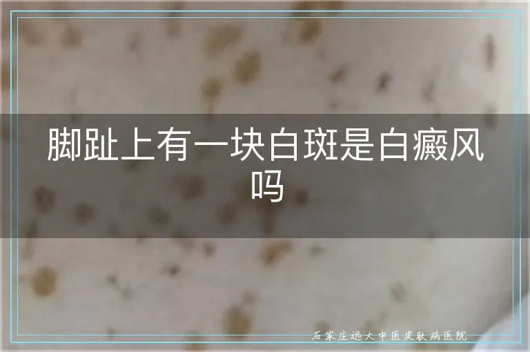 脚趾上有一块白斑是白癜风吗