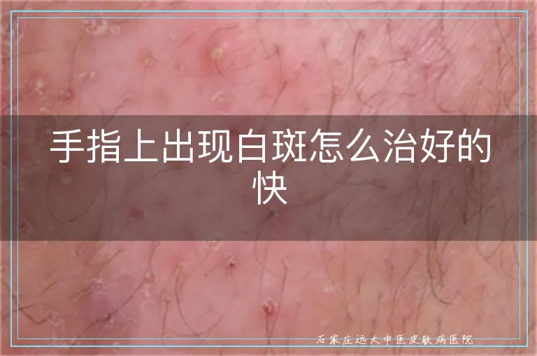 手指上出现白斑怎么治好的快