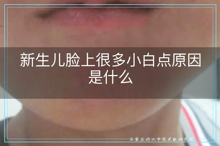 新生儿脸上很多小白点原因是什么