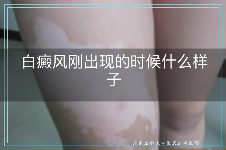 白癜风刚出现的时候什么样子