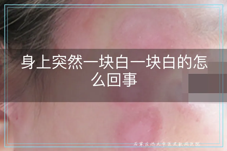 身上突然一块白一块白的怎么回事