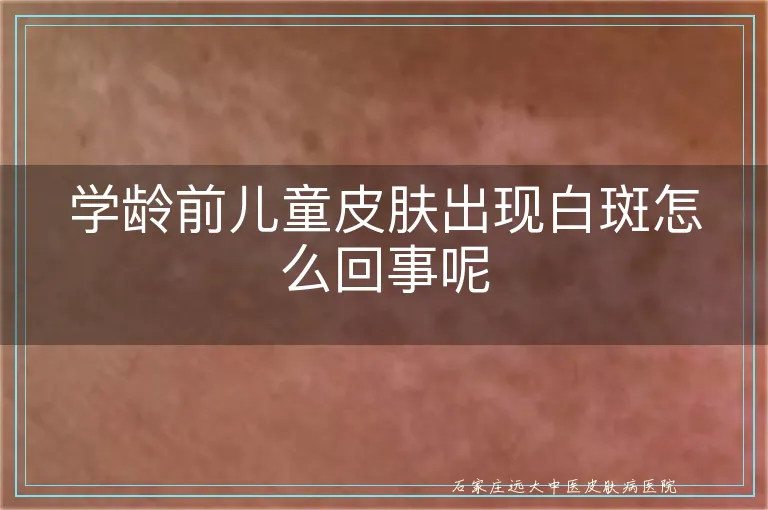 学龄前儿童皮肤出现白斑怎么回事呢
