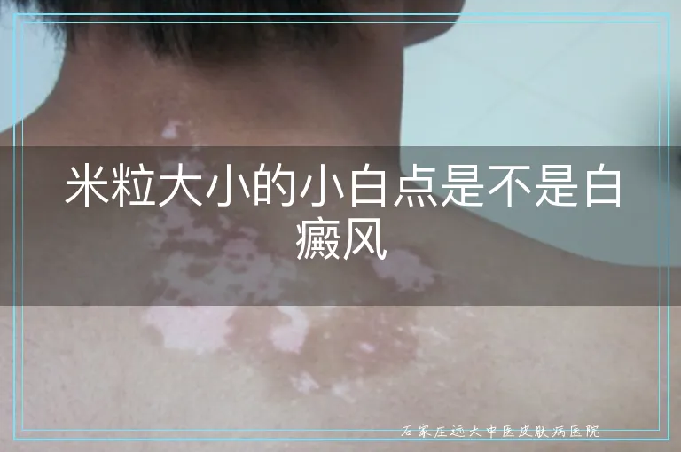 米粒大小的小白点是不是白癜风