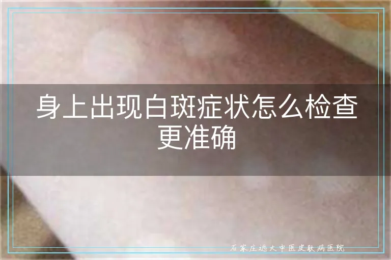身上出现白斑症状怎么检查更准确