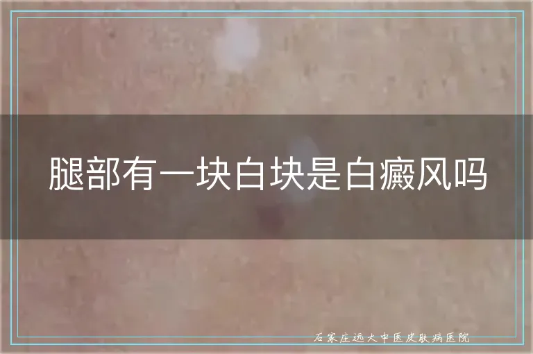 腿部有一块白块是白癜风吗