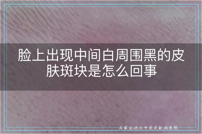 脸上出现中间白周围黑的皮肤斑块是怎么回事