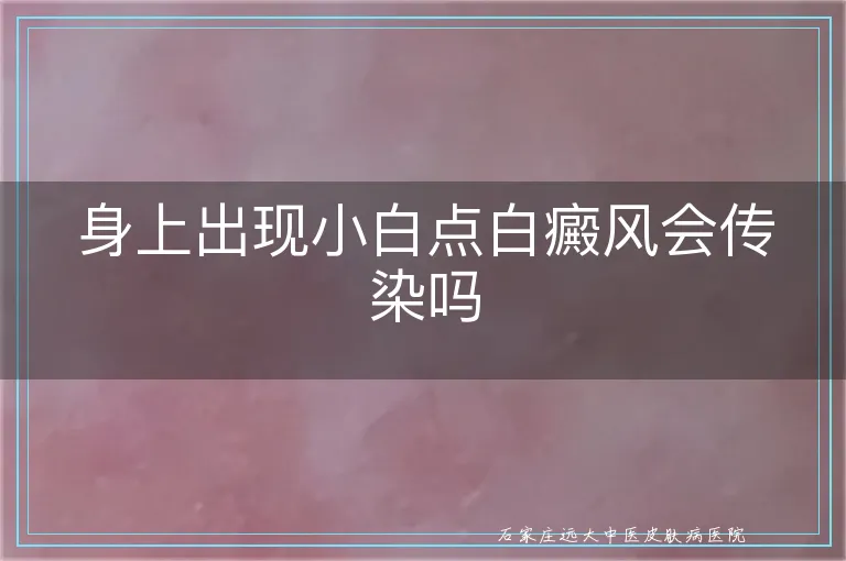 身上出现小白点白癜风会传染吗