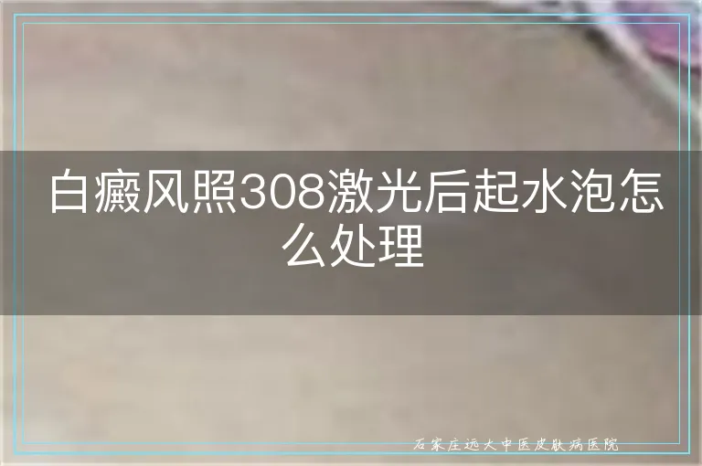 白癜风照308激光后起水泡怎么处理