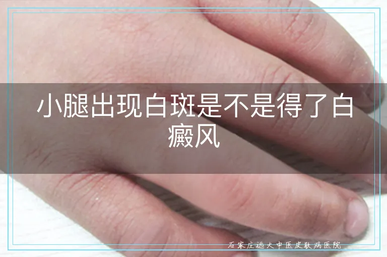 小腿出现白斑是不是得了白癜风