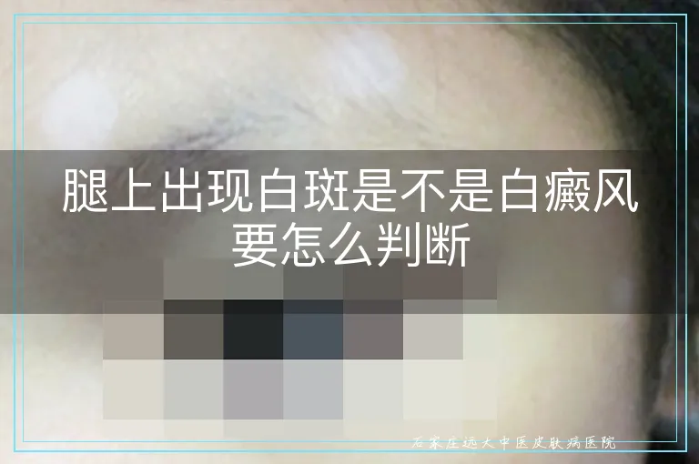 腿上出现白斑是不是白癜风要怎么判断