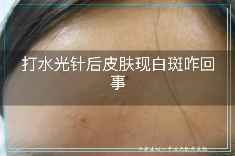 打水光针后皮肤现白斑咋回事